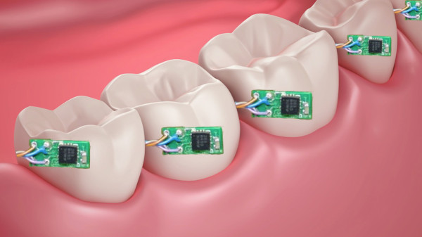 Sensor-Embedded-On-Teeth