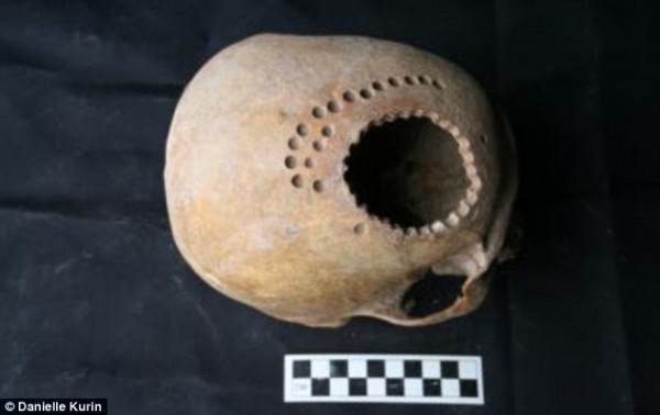 1000-year-old-Skull-With-Trepanning