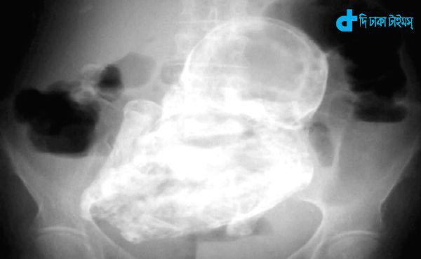 92-year-old woman's womb and fetal mummy-2