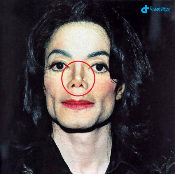 Michael Jackson's & nose lost-2