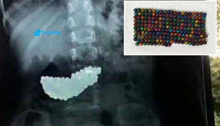 190 balls of beads were found in the baby's stomach! 1 ১৯০টি পুঁতির বল পাওয়া গেলো শিশুর পেটে! 1