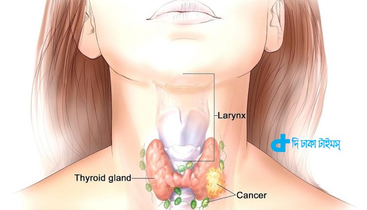 গলায়-ঘাড়ে কোনো লক্ষণ দেখলেই ক্যান্সারের আশঙ্কা? 1