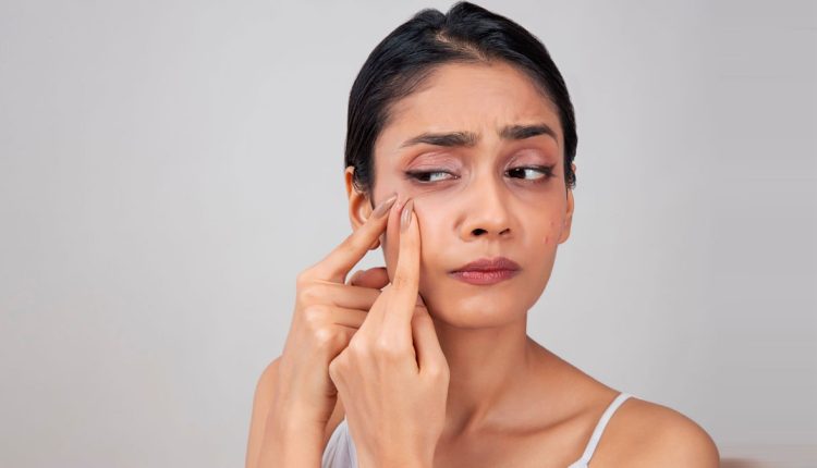 স্বাস্থ্য ভালো মানেই কী বেশি ব্রণ? 1 স্বাস্থ্য ভালো মানেই কী বেশি ব্রণ? 1