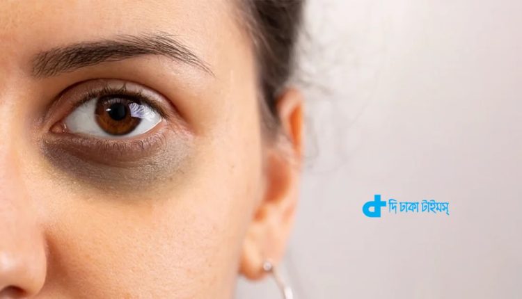 চোখের নীচের ফোলা ভাব দূর করতে ঘরোয়া উপাদান ব্যবহার করুন 1 চোখের নীচের ফোলা ভাব দূর করতে ঘরোয়া উপাদান ব্যবহার করুন 1