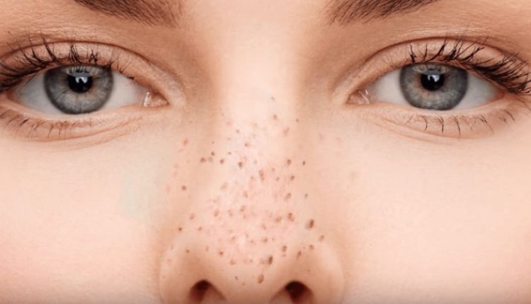 নাকের ব্ল্যাকহেডস তাড়াতে মধু ব্যবহার করতে হবে যে নিয়ম মেনে 1 নাকের ব্ল্যাকহেডস তাড়াতে মধু ব্যবহার করতে হবে যে নিয়ম মেনে 1