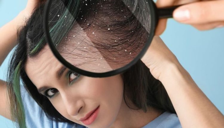 খুশকি দূর করতে আপনাকে যা যা করতে হবে 1 খুশকি দূর করতে আপনাকে যা যা করতে হবে 1