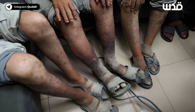 মুক্তি পাওয়া ফিলিস্তিনিদের শরীরে ভয়াবহ নির্যাতনের চিহ্ন 2 মুক্তি পাওয়া ফিলিস্তিনিদের শরীরে ভয়াবহ নির্যাতনের চিহ্ন 2