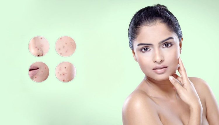 মুখের ব্রণ হলে আপনাকে যা যা করতে হবে 1