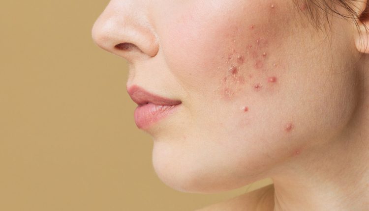 প্রসাধনী মেখেও ব্রণ না গেলে করণীয় কী? 1 প্রসাধনী মেখেও ব্রণ না গেলে করণীয় কী? 1