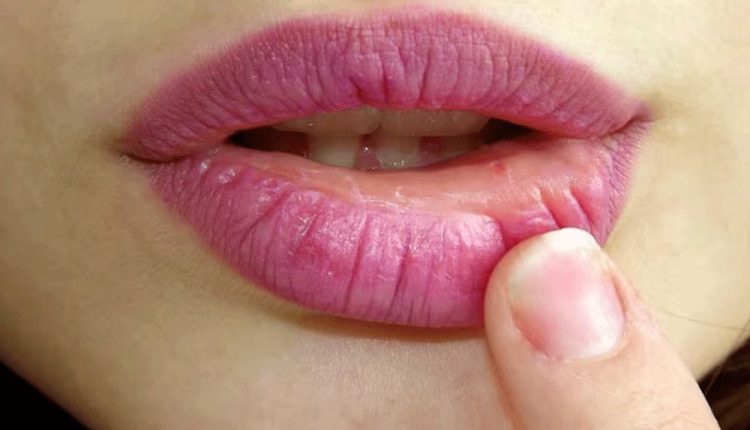 শীতে ঠোঁট ফাটা হতে রক্ষা পেতে করণীয় 1 শীতে ঠোঁট ফাটা হতে রক্ষা পেতে করণীয় 1